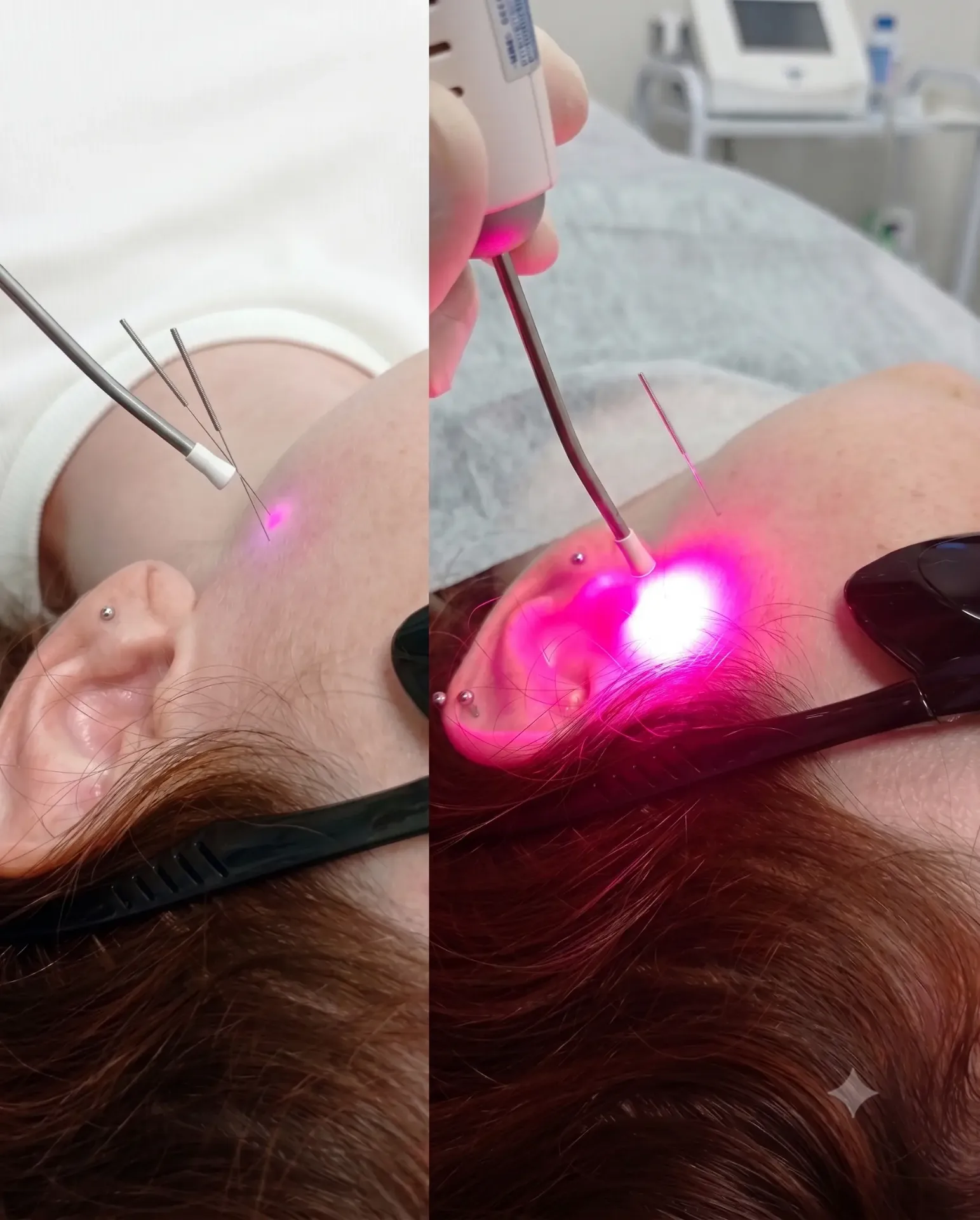 Laserterapia e agulhamento seco em pontos-gatilho