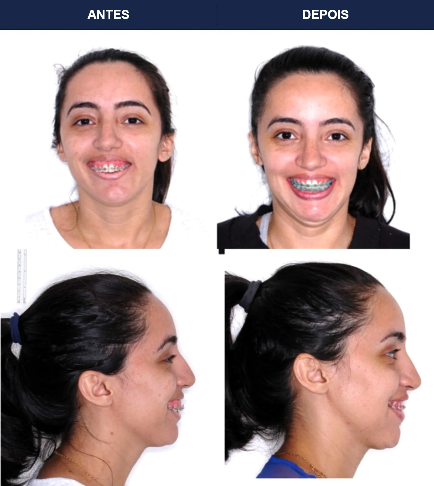Caso clínico de cirurgia ortognática — Correção de Classe III com harmonização do terço inferior. Imagens pré e pós-operatórias.