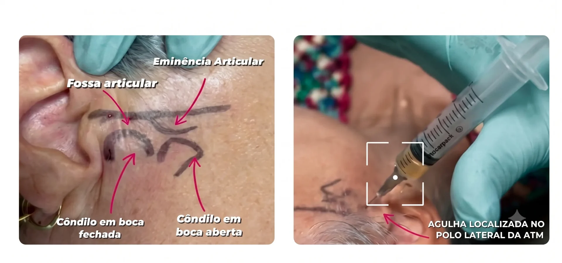 Procedimento de bioestimulação intra-articular com concentrado plaquetário na ATM