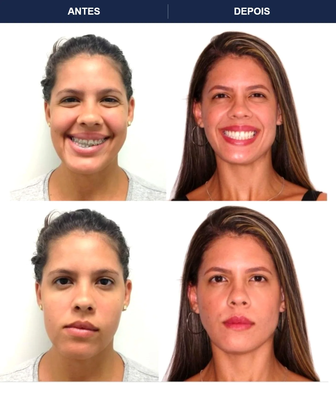 Caso clínico de cirurgia ortognática — Correção de Classe III — vistas em três quartos e perfil. Imagens pré e pós-operatórias.