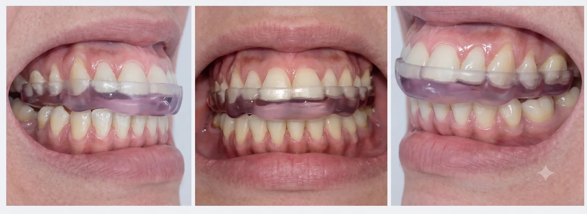 Placa oclusal estabilizadora feita sob medida