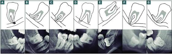 Painéis com esquemas e radiografias mostrando diferentes relações entre as raízes do terceiro molar inferior e o canal do nervo alveolar inferior