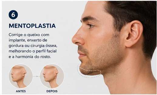 Mentoplastia — correção estética do queixo