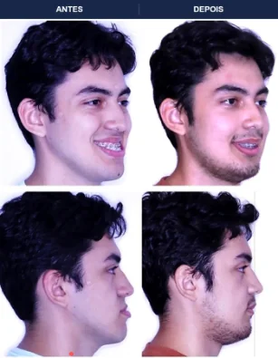 Caso clínico de cirurgia ortognática — Correção de Classe II com equilíbrio facial. Imagens pré e pós-operatórias.