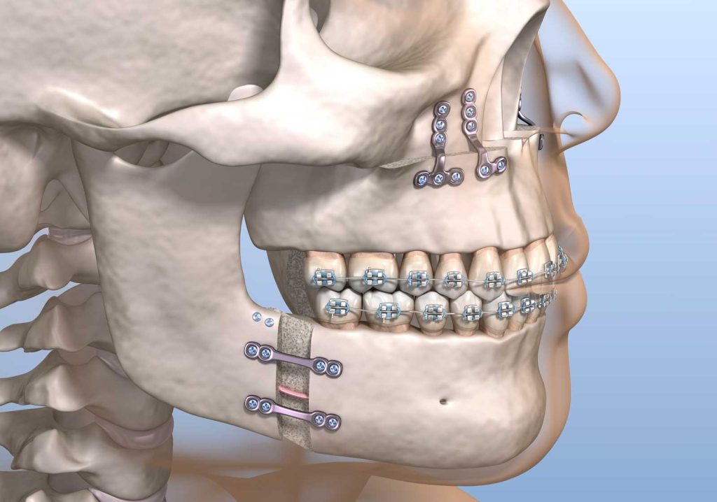 Entenda a Cirurgia Ortognática no Rio de Janeiro com Doutor Guilherme Lima